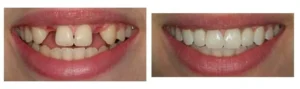 Side-by-side comparison of a person's smile before and after dental implants in Sacramento, showing missing and misaligned teeth on the left and straight, complete teeth on the right.