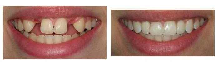Side-by-side comparison of a person's smile before and after dental implants in Sacramento, showing missing and misaligned teeth on the left and straight, complete teeth on the right.