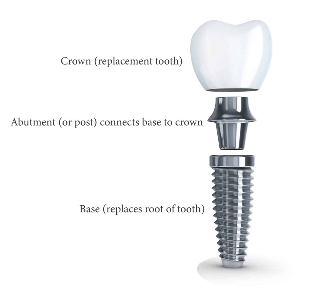Diagram of a dental implant showing three parts: crown (replacement tooth), abutment (connects crown to base), and base (replaces root of tooth).