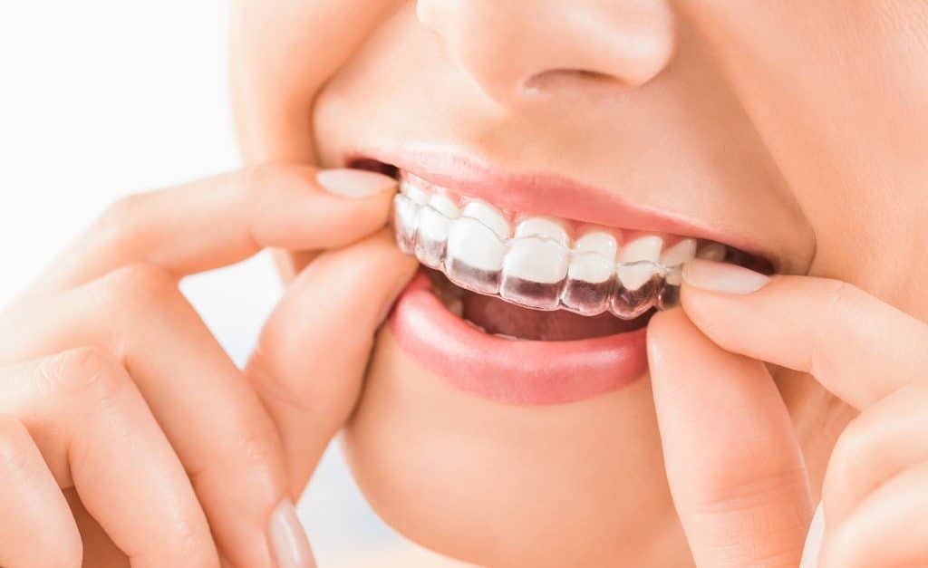 Contact the smile doctor for invisalign treatment