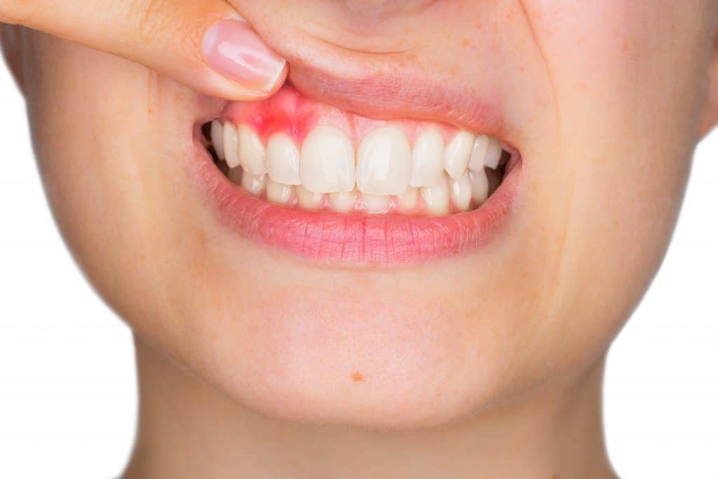gingivitis treatment at the smile doctor