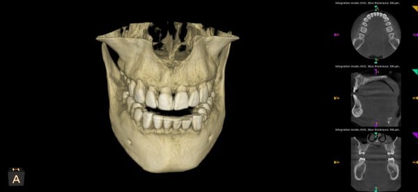 3D dental imaging in Sacramento: 3D dental scan of a human skull showing teeth alignment and jaw structure, with additional cross-sectional jaw images on the right side for precise treatment planning.
