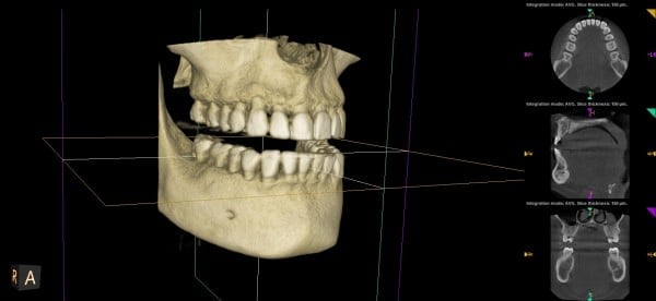 3D dental scan showing upper and lower jawbone structure, with cross-sectional CT images of the jaw displayed on the right side of the screen, using low-radiation technology for a safe diagnostic teatment.