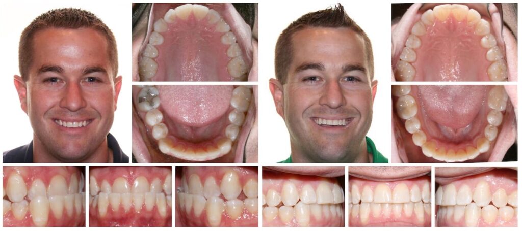 Two sets of dental photos showing a man before and after orthodontic treatment, including full face, upper palate, and close-ups of teeth alignment.