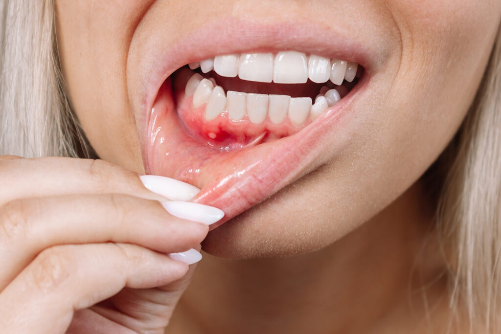 A person pulls down their lower lip to reveal a red, swollen sore or ulcer on the inner gum, a common sign of oral inflammation.