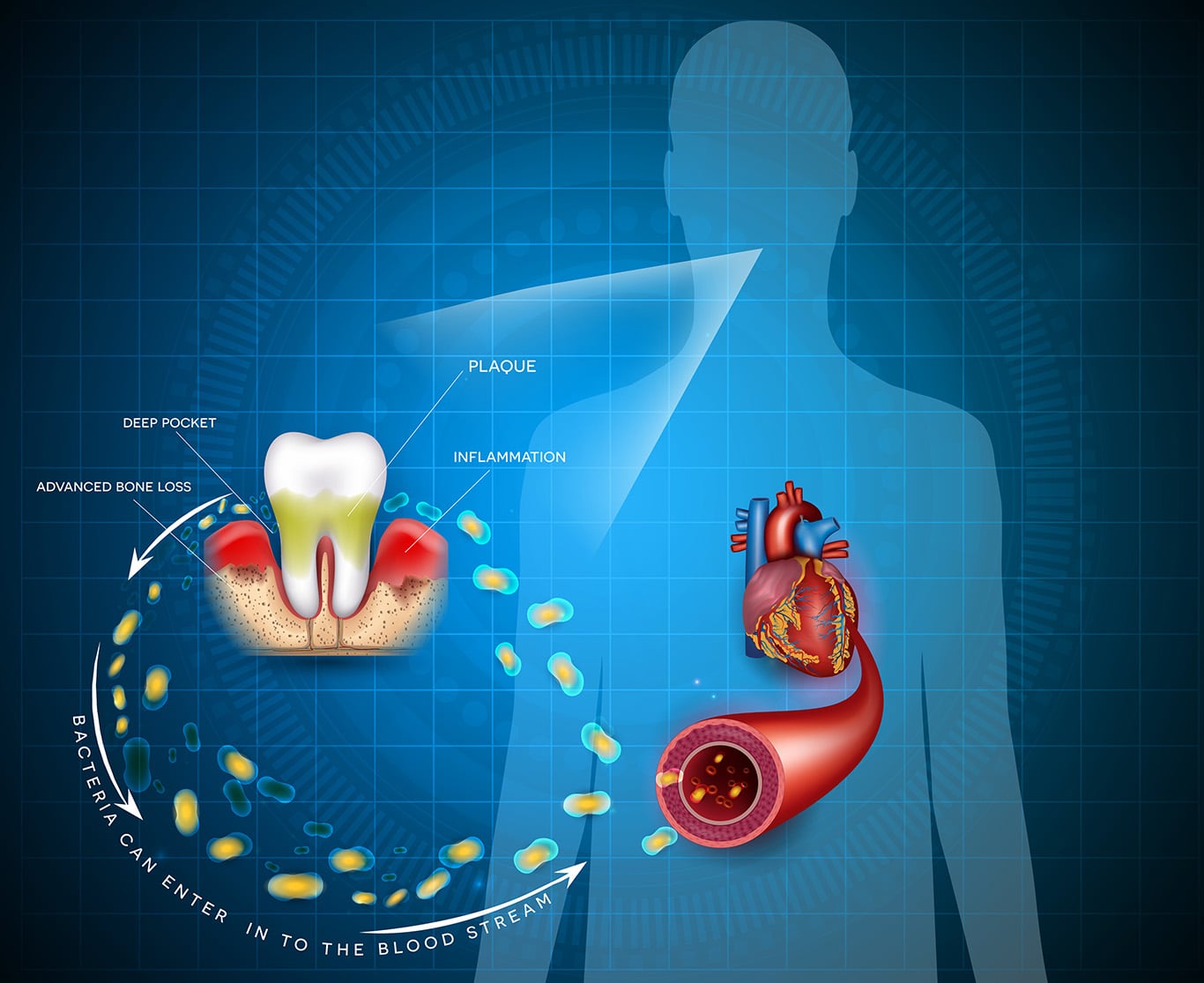 Gum disease inflammation bacteria can enter in to the blood stream an affect the heart. Periodontitis disease anatomy on an abstract blue background on our Gum disease treatment page