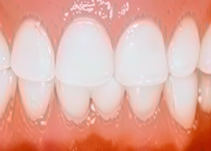 Close-up view of a set of human teeth with two overlapping lower front teeth against a pink gum background, highlighting the need for periodontal care and gum disease treatment.