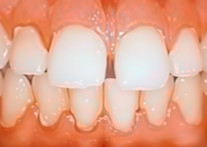 Close-up of human teeth with noticeable gaps between the upper and lower front teeth, often seen in individuals seeking gum disease treatment or those with periodontal concerns.