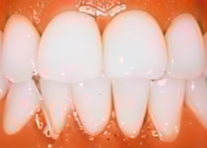Close-up view of a set of straight, white teeth, showing both upper and lower rows after gum disease treatment for improved periodontal health.