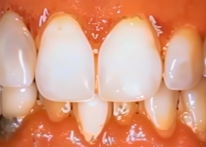Close-up of human teeth showing an overbite with the upper front teeth overlapping the lower front teeth, which may increase the risk for periodontal issues and require gum disease treatment.