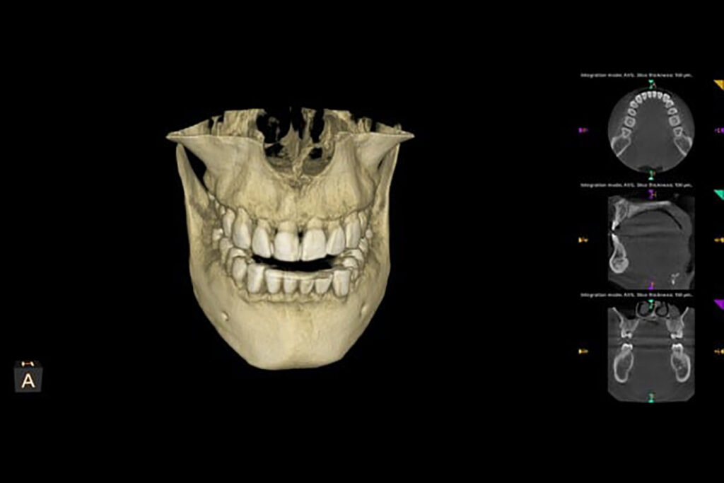 3D CT scan of a human skull displaying teeth and jaw structure, with cross-sectional images on the right side—ideal for oral health assessment and dental diagnostic services.
