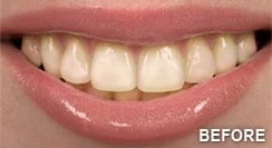 Close-up of a person's mouth showing their upper teeth with some discoloration and unevenness, highlighting the need for teeth whitening. The word "BEFORE" is written in the lower right corner.