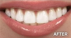 A close-up of a smiling mouth showing bright, even, white teeth after teeth whitening, with the word "AFTER" in the bottom right corner.
