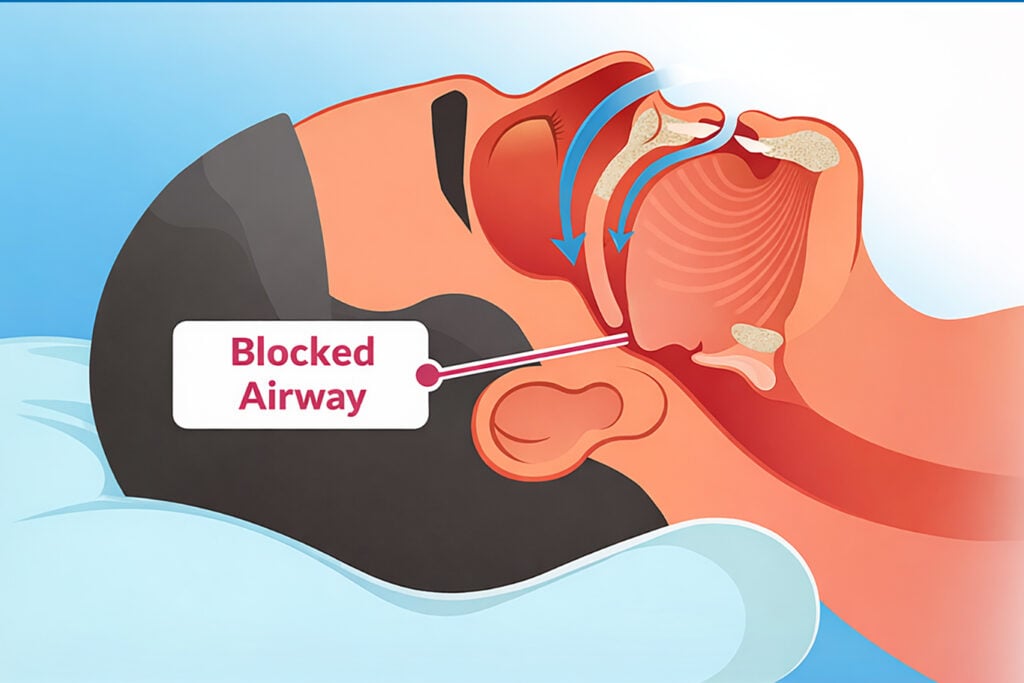 Diagram of a person lying on their back with a label indicating a blocked airway at the throat, illustrating sleep apnea or airway obstruction, which may benefit from dental medical treatments.