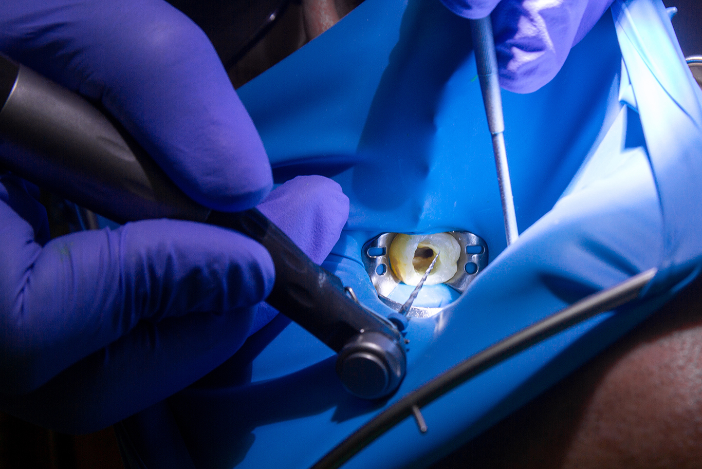 A dentist wearing purple gloves carefully performs a root canal on a tooth isolated with a blue dental dam.