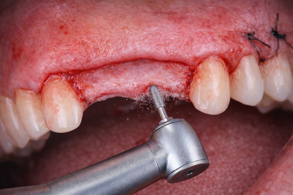 Close-up of an oral surgery procedure, showing a drill creating a hole in the upper gum with missing teeth, preparing for a dental implant; gums are stitched and there is some bleeding.