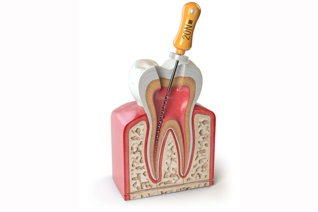 Cross-section of a tooth model showing a dental file inserted into the root canal, illustrating an endodontics root canal treatment procedure.