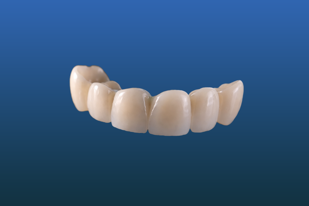 A dental bridge with six artificial teeth, highlighting advanced restorative dentistry treatments, is shown against a blue gradient background.