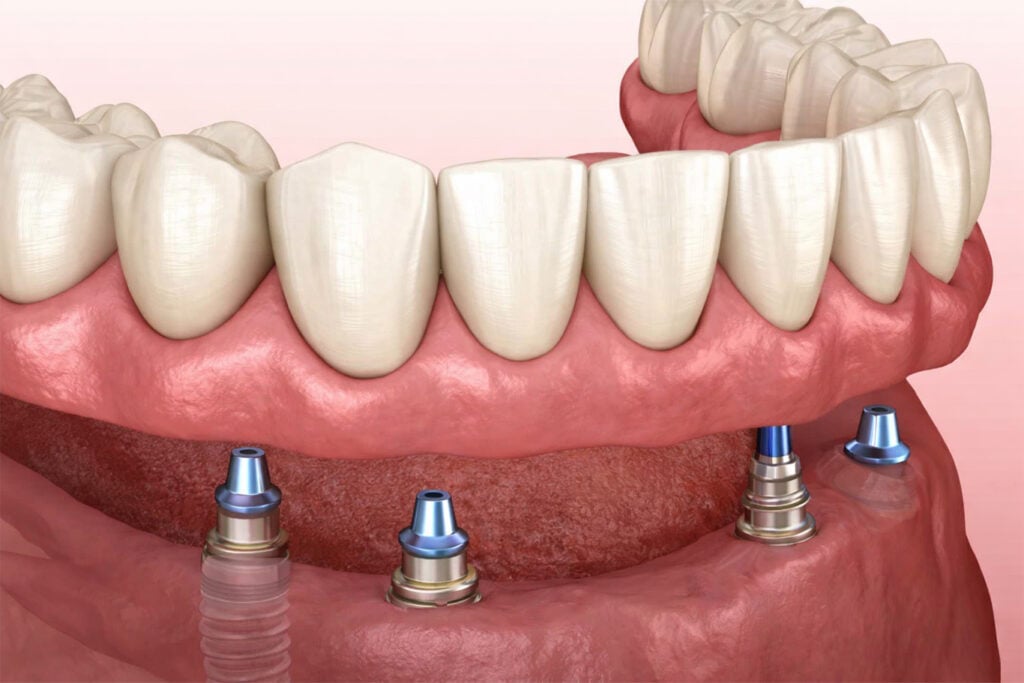 3D illustration of a lower dental arch with four dental implants placed in the jawbone, supporting a set of artificial teeth—an advanced solution in restorative dentistry treatments.