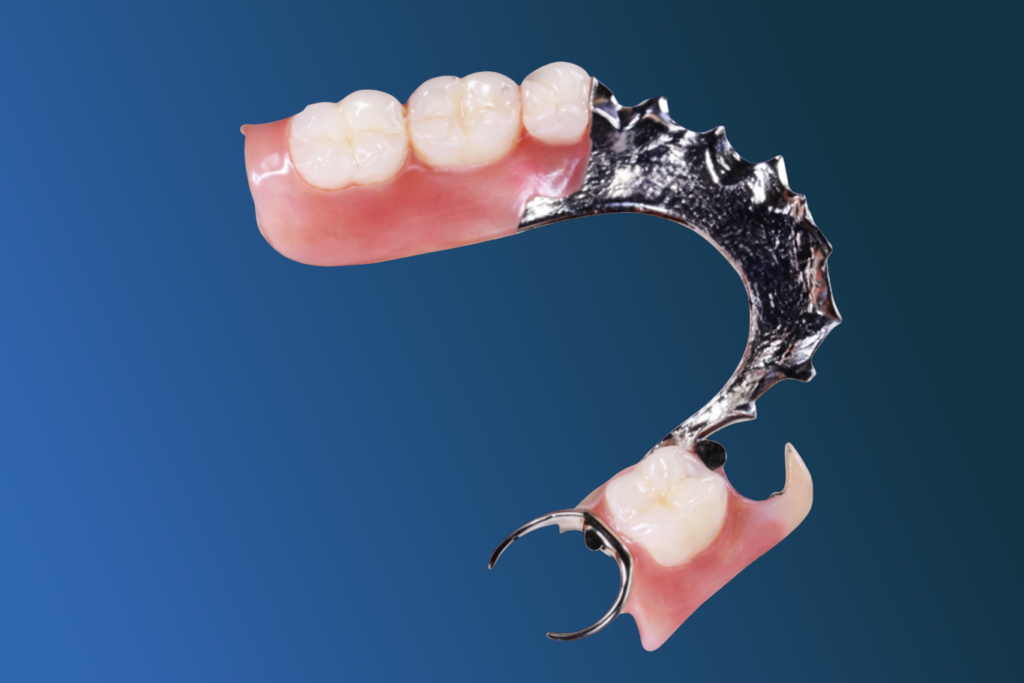 A partial denture with artificial teeth and a metal framework—an example of restorative dentistry treatments—designed to replace missing upper and lower teeth, shown against a blue gradient background.