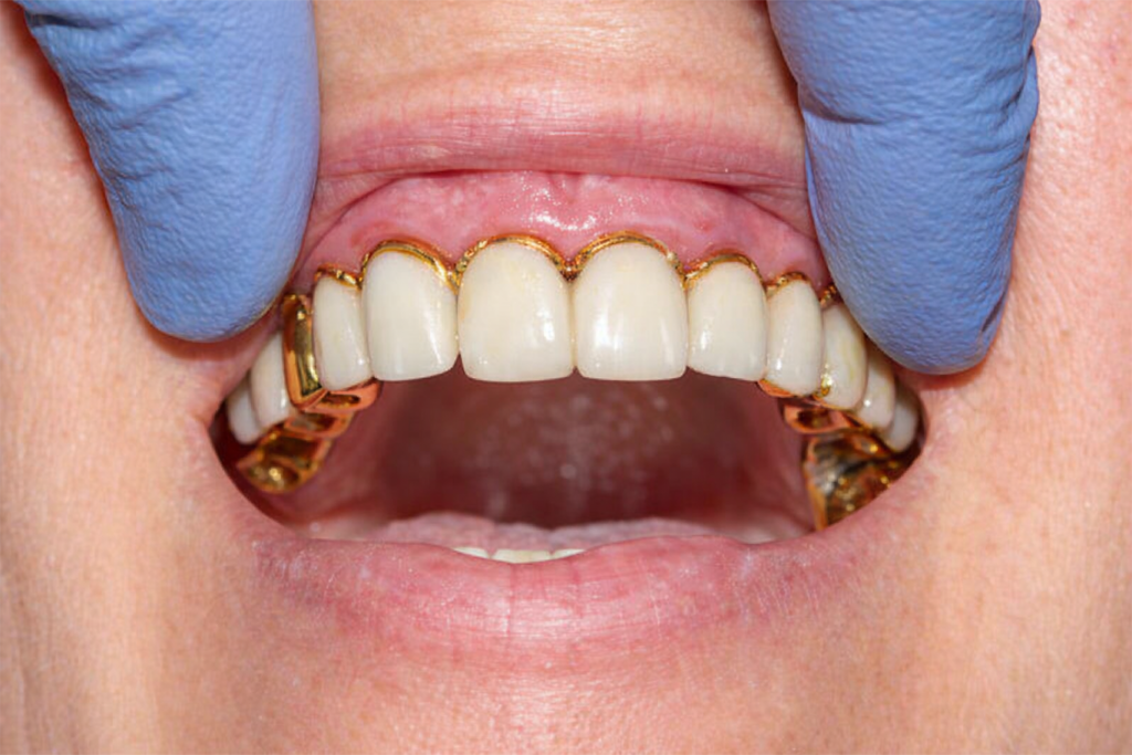 A close-up of a person's mouth showing upper and lower teeth with gold dental crowns; gloved hands are holding the lips open, highlighting restorative dentistry treatments.