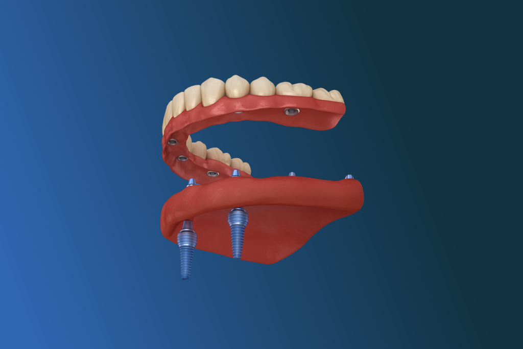 Rejuvenating Dentures in Sacramento | The Smile Doctor