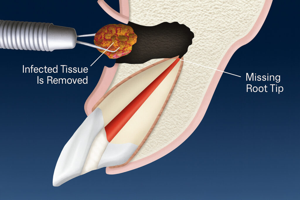 Medical illustration showing apical curettage and removal of infected tissue and missing root tip from a tooth, with labeled sections indicating root canal therapy steps in endodontics in Sacramento.