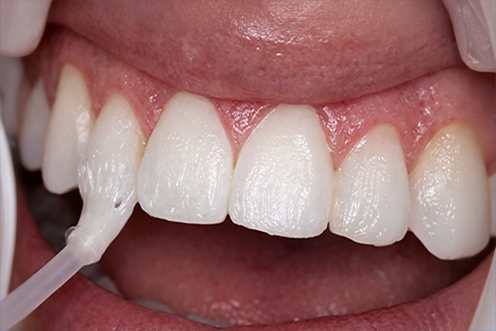 Close-up of a person's upper front teeth with a dental retractor in place, exposing the gums and teeth for preventive services during a dental procedure.
