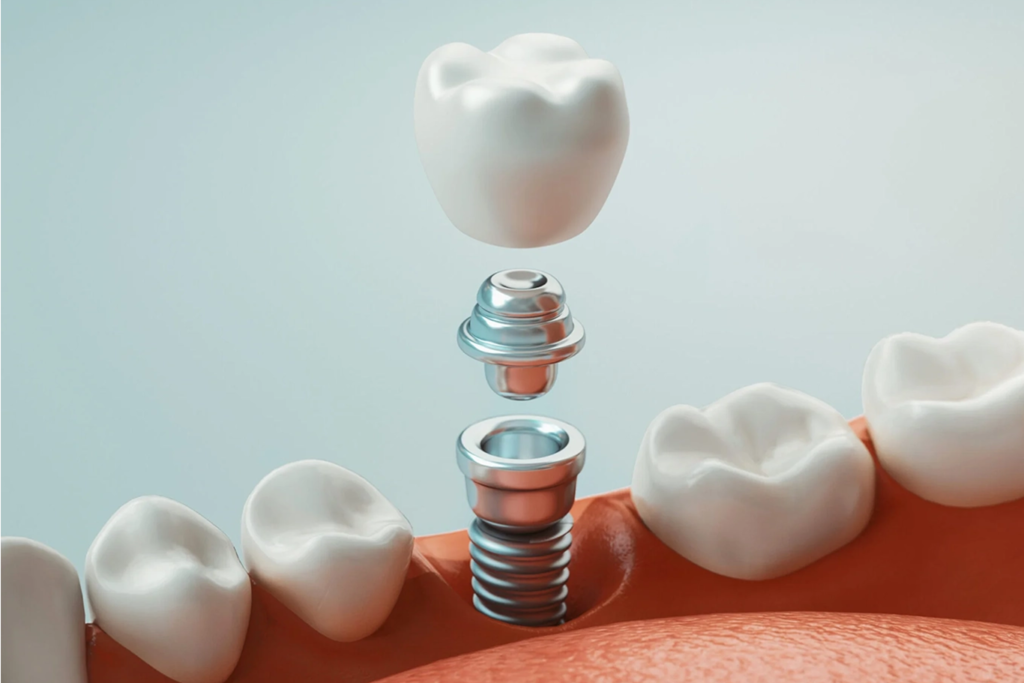 A 3D illustration showing the parts of a dental implant—crown, abutment, and screw—assembled above a gum with natural teeth, highlighting restorative dentistry treatments.