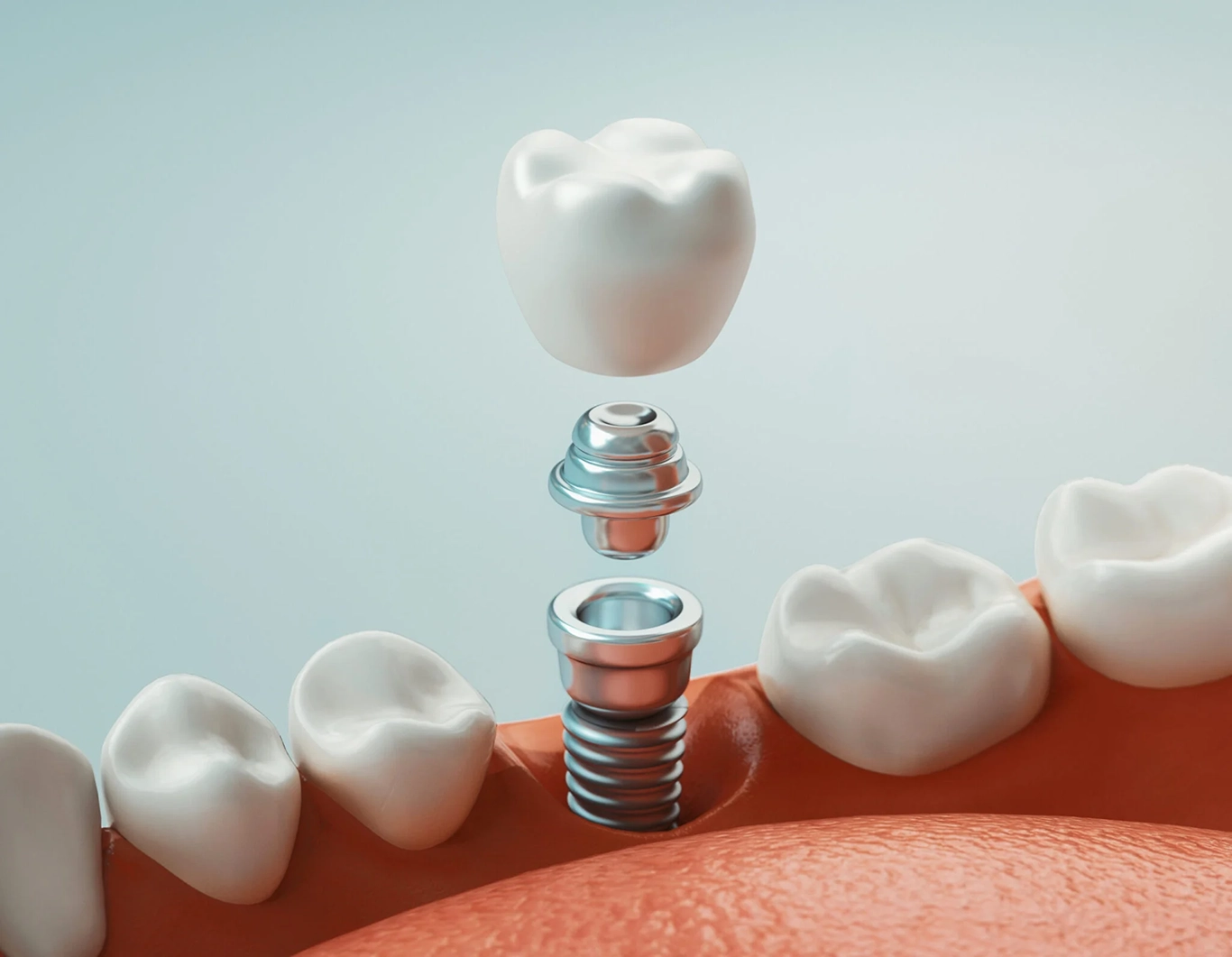 dental implants at The Smile Doctor