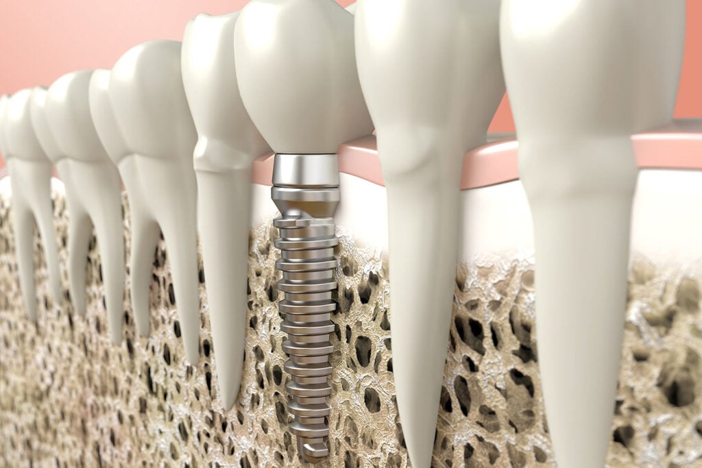 Cross-sectional illustration showing a dental implant embedded in the jawbone among natural teeth, highlighting the metal post, artificial crown, and the role of oral surgery in restoring function.