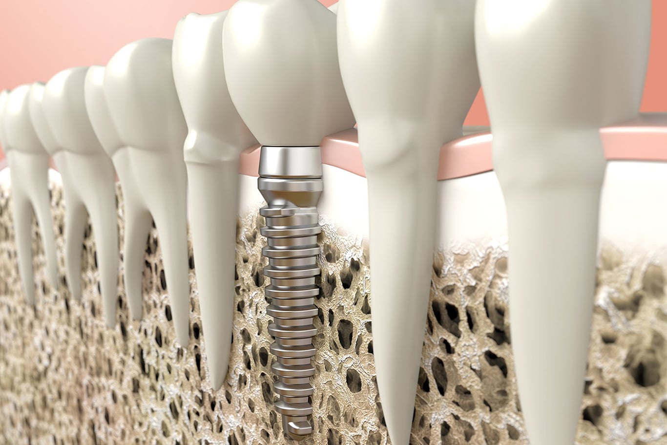 Cross-sectional illustration showing a dental implant embedded in the jawbone among natural teeth, highlighting the metal post, artificial crown, and the role of oral surgery in restoring function.