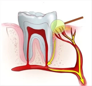 Diagram of a tooth showing nerves and blood vessels, with arrows indicating the path from the tooth root to the nerves and blood supply—important for understanding gum inflammation and its possible links to stroke risk.