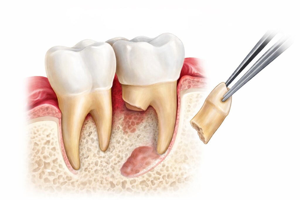 Illustration of a partially erupted wisdom tooth being extracted with forceps, showing the gum, bone, and adjacent teeth—procedures like apicoectomy or root canal therapy may be considered for nearby teeth if infection is present.