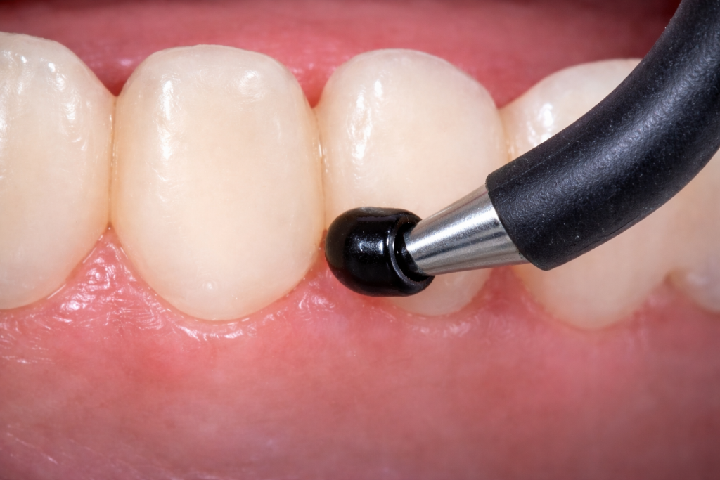 A dental curing light is being used on the gumline near the front teeth during an oral examination, as part of comprehensive dental diagnostic services.