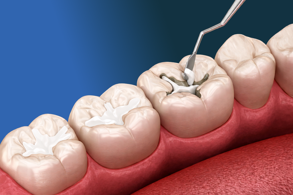 A dental tool fills a cavity in a molar with a silver amalgam filling, while surrounding teeth—protected by preventive services—show white fillings, all set in a realistic gum and tooth illustration.