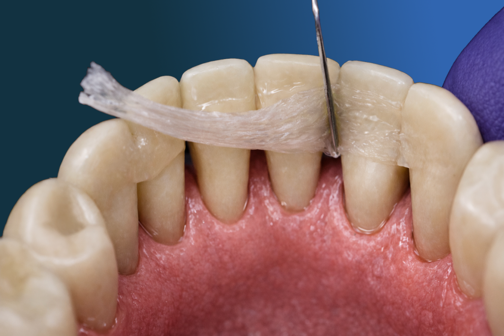 Close-up of a dental procedure showing a dental floss threader being used to clean between teeth and control plaque near the gumline, highlighting the importance of preventive services in maintaining oral health.