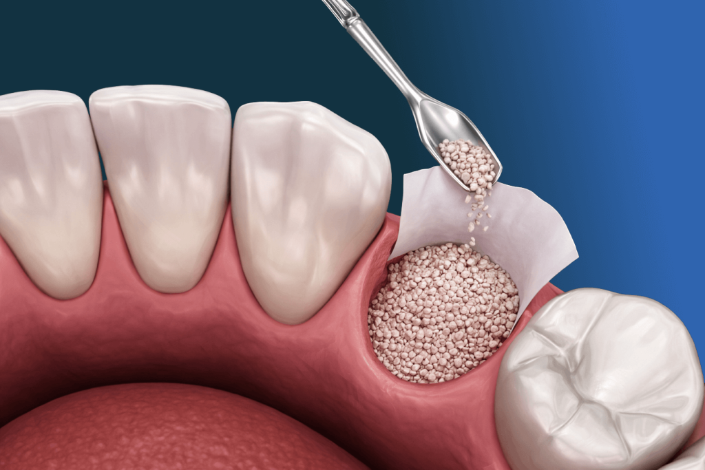 A dental bone graft procedure during oral surgery showing granules being placed into a tooth socket between natural teeth in a human gum model.